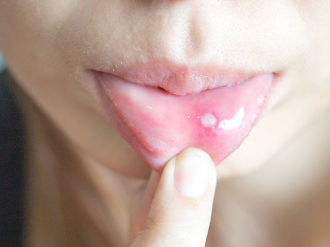 Khi nào nổi đẹn là nghiêm trọng?