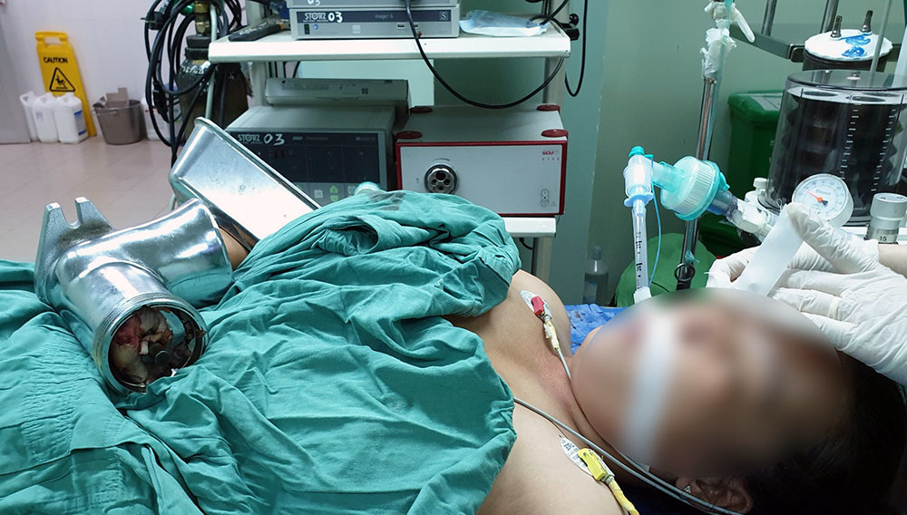 Máy xay chả cá cuốn nát cánh tay người phụ nữ ở miền Tây