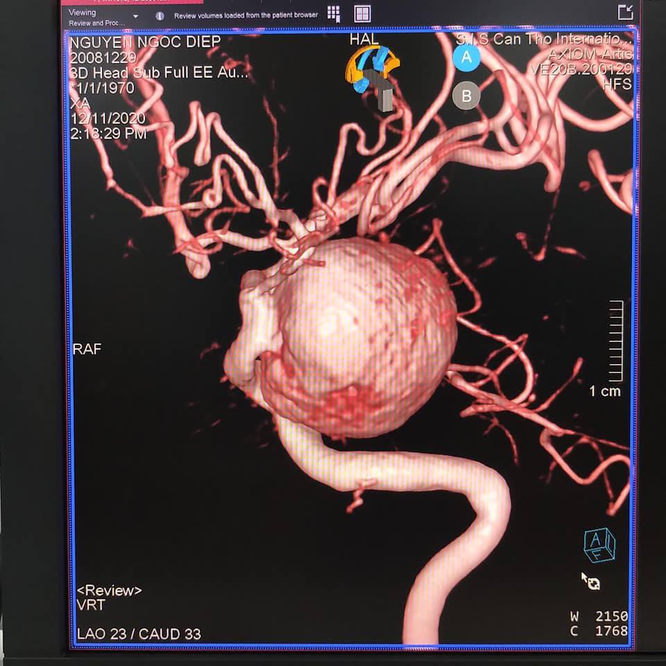 Nhức đầu nhiều năm, người phụ nữ sốc khi biết mình mang 'bom máu' trong não