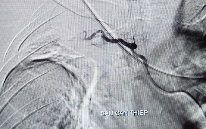 Cần Thơ: Huy động bác sĩ 5 chuyên khoa cứu bệnh nhân "ho ra máu sét đánh"