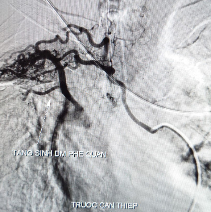 Cần Thơ: Huy động bác sĩ 5 chuyên khoa cứu bệnh nhân "ho ra máu sét đánh"