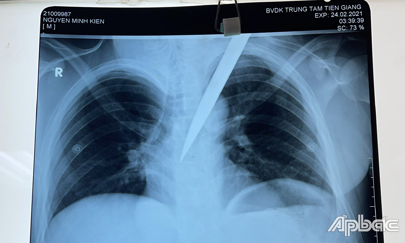 Bệnh viện Đa khoa trung tâm Tiền Giang: Phẫu thuật thành công bệnh nhân bị đâm thấu ngực