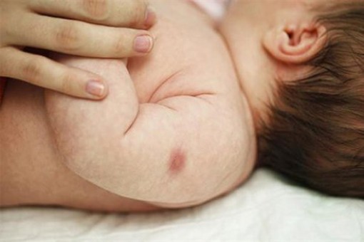Cha mẹ cần lưu ý khi trẻ bị biến chứng sau tiêm vaccine