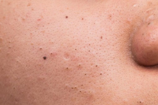 Những loại mụn bạn tuyệt đối không được nặn
