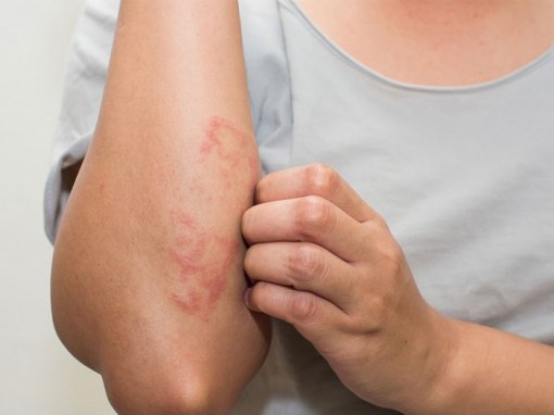 Người mắc bệnh chàm nặng có nguy cơ cao bị đột quỵ