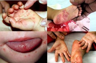Cách nhận biết bệnh tay chân miệng ở trẻ