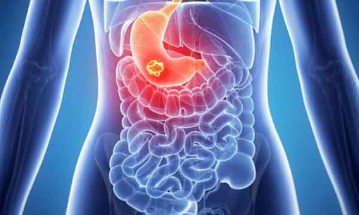 Ung thư đường tiêu hóa dễ nhầm với các bệnh thông thường