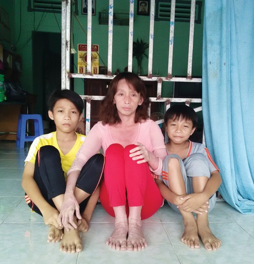 12 năm khổ sở vì căn bệnh vẩy nến hành hạ
