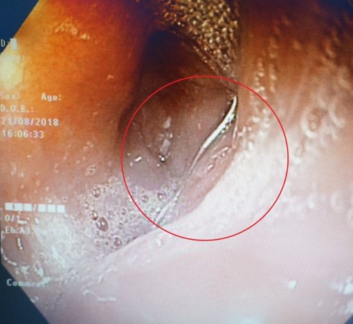 Vĩnh Long: Thanh kẽm 7cm nằm trong thực quản của người đàn ông