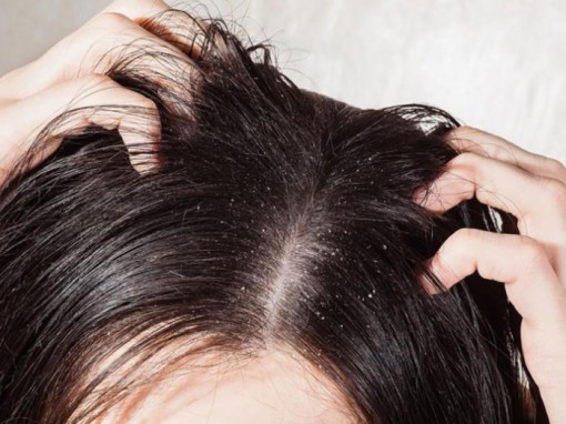 Làm sao đối phó hiệu quả với gàu?
