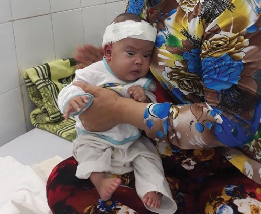 Bé sơ sinh bị não úng thủy và thoát vị tủy cần giúp đỡ