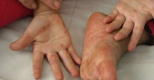 Bé 2 tuổi ở Bến Tre tử vong do bệnh tay chân miệng