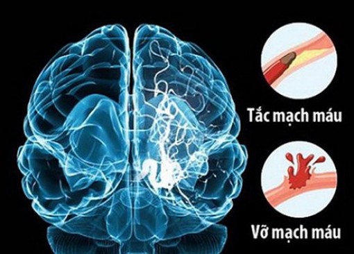 ĐBSCL: Mỗi năm có hơn 10.000 trường hợp đột quỵ