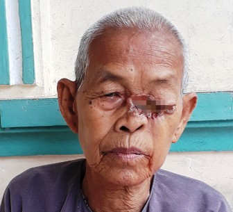 Bà lão với vết lở ở mắt không tiền chữa trị
