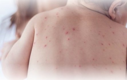 Khẩn trương tăng cường công tác phòng, chống bệnh sởi