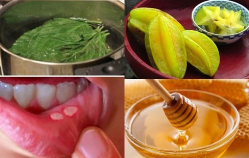 Mẹo nhỏ đánh bay nhiệt miệng sau 1 đêm