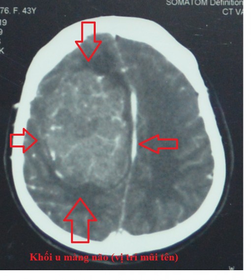 Phẫu thuật thành công khối u màng não lớn, nguy hiểm tính mạng