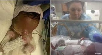 Chuyện lạ ở Mỹ: Bé trai sinh ra không có da