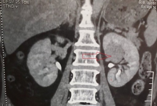 Cứu bệnh nhân bằng phương pháp mổ nội soi sau phúc mạc cắt thận