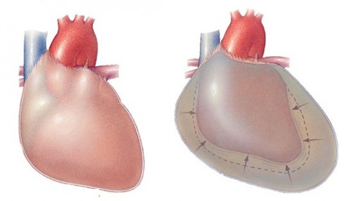 Cứu thành công ca đột quỵ ngưng tim, ngưng thở