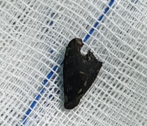 Hạt vú sữa nằm lâu ngày trong phổi người đàn ông