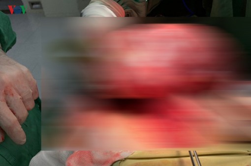 Phẫu thuật thành công cho bệnh nhân có khối u gan nặng 1,3kg