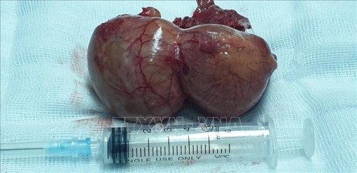 Can thiệp thành công ca bệnh nang màng ngoài tim hiếm gặp