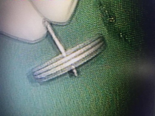 Cứu bé trai nuốt dị vật bằng kim loại vừa to, vừa sắt nhọn