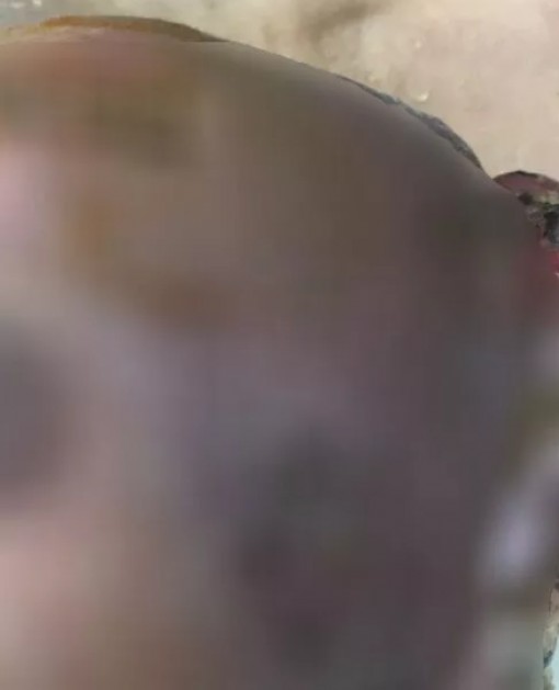 Vì cả tin, bầu ngực 1 phụ nữ ở Vĩnh Long biến dạng đáng sợ