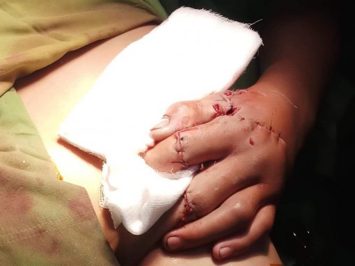 Điều trị thành công trường hợp bàn tay dập nát do dùng pháo tự chế