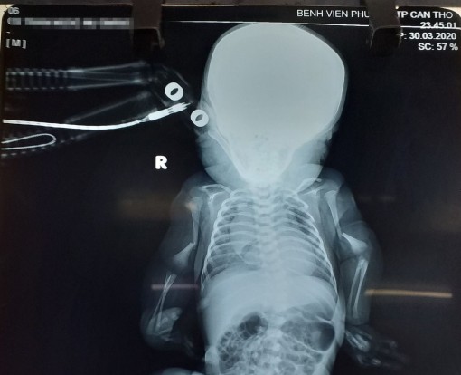 Phát hiện trẻ sơ sinh mắc bệnh xương thủy tinh rất hiếm gặp