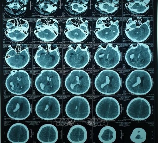 Áp dụng kỹ thuật mới cứu sống người xuất huyết não tại Đồng bằng sông Cửu Long