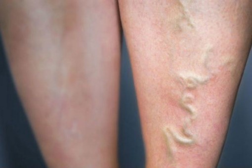 Da nổi mạch máu: Căn bệnh nguy hiểm 300 triệu người mắc