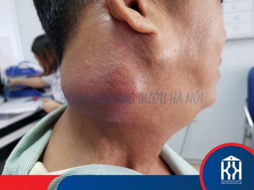 Sờ thấy hạch ở cổ, dấu hiệu cảnh báo ung thư?
