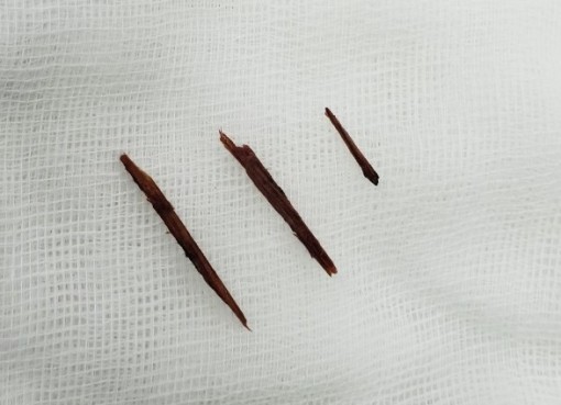 Cưa cây, dăm gỗ văng thủng bụng