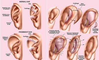 Nâng mũi từ sụn vành tai có lợi ích gì?