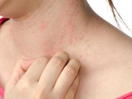 Các bệnh ngoài da thường gặp