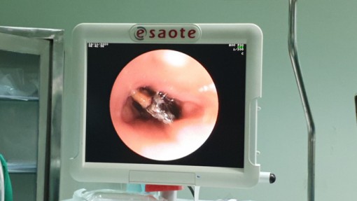 Căng thẳng lấy hạt hồng xiêm nằm 27 năm trong phế quản của người phụ nữ