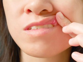 Vết loét miệng hay bị bỏ qua có thể là dấu hiệu của ung thư