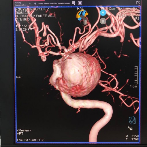 Nhức đầu nhiều năm, người phụ nữ sốc khi biết mình mang 'bom máu' trong não