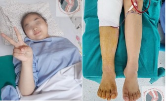 Kỳ tích bệnh nhi nhỏ tuổi nhất Việt Nam được thay toàn bộ xương đùi