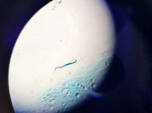 An Giang: Phát hiện ấu trùng giun lươn trong đàm bệnh nhân COPD