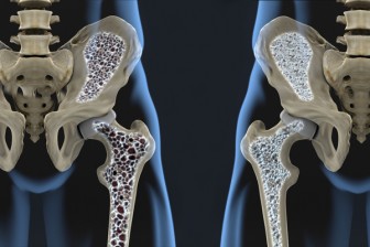Căn bệnh âm thầm triệu người mắc khiến xương người phụ nữ vỡ vụn