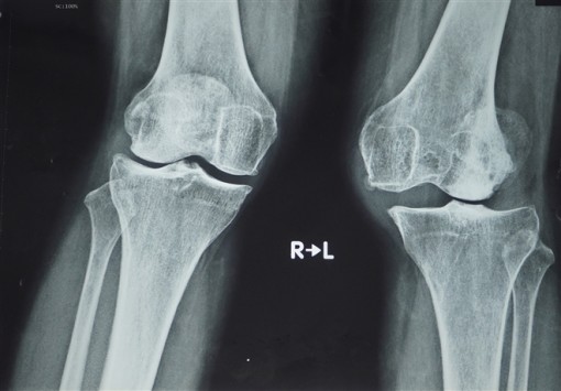 Lần đầu tại Việt Nam phẫu thuật thay khớp gối dạng bản lề bằng titanium