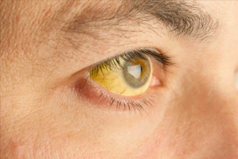 6 thay đổi sớm nhất từ đôi mắt: Dấu hiệu cảnh báo về các khối u hoặc ung thư