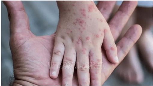 EU mua 110.000 liều vaccine ngừa bệnh đậu mùa khỉ