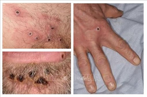 Anh: Triệu chứng bệnh đậu mùa khỉ khác so với các đợt bùng phát trước đây