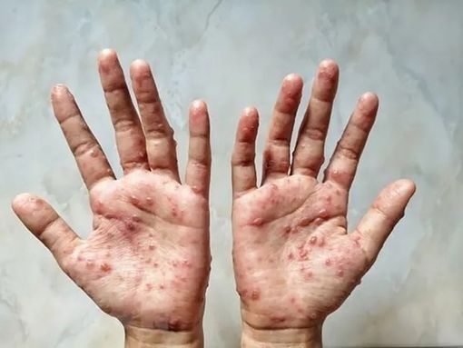 Ấn Độ, Saudi Arabia xuất hiện ca bệnh đậu mùa khỉ đầu tiên
