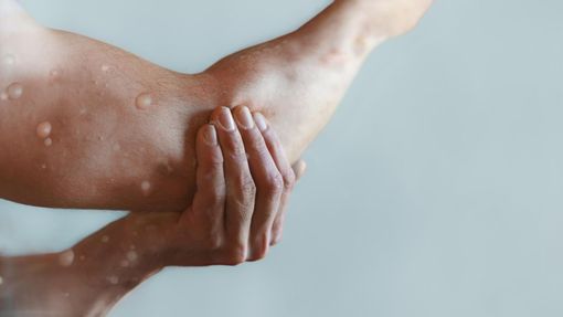 Thế giới ghi nhận 14 nghìn ca mắc bệnh đậu mùa khỉ