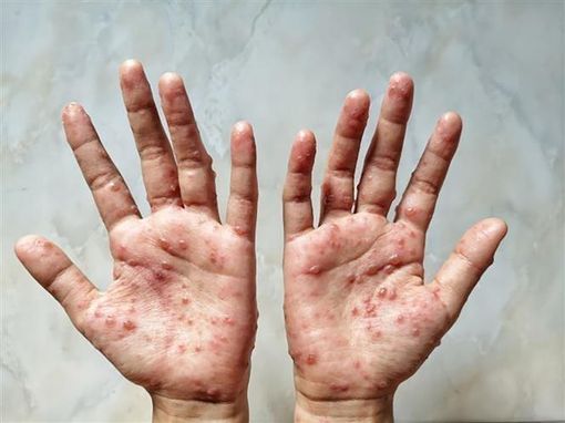 Nhật Bản ghi nhận ca đậu mùa khỉ đầu tiên
